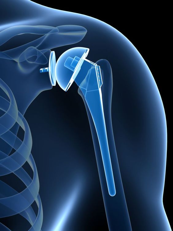 Best Joint replacement surgery in Begur